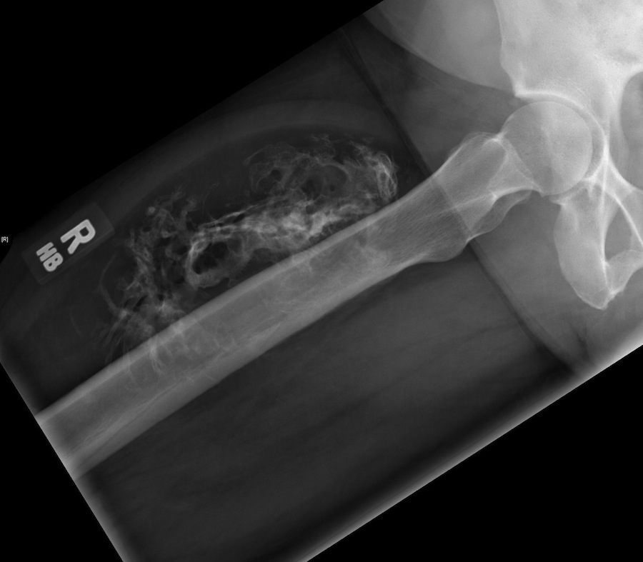 Figure 2 for case Intramuscular lipoma ( RID4350 )